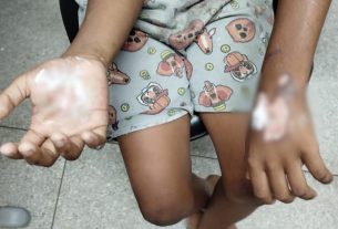 Detida no Namibe cidadã acusada de queimas mãos da filha