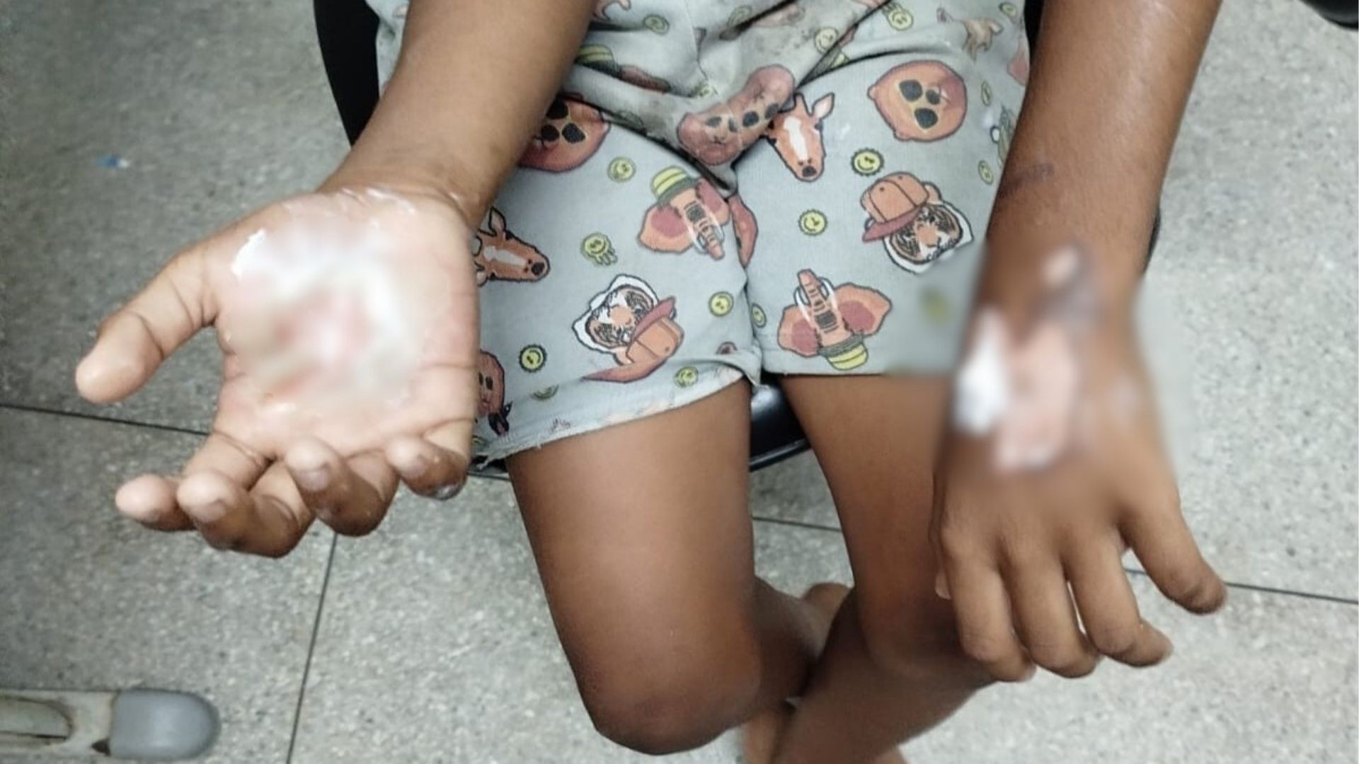 Detida no Namibe cidadã acusada de queimas mãos da filha
