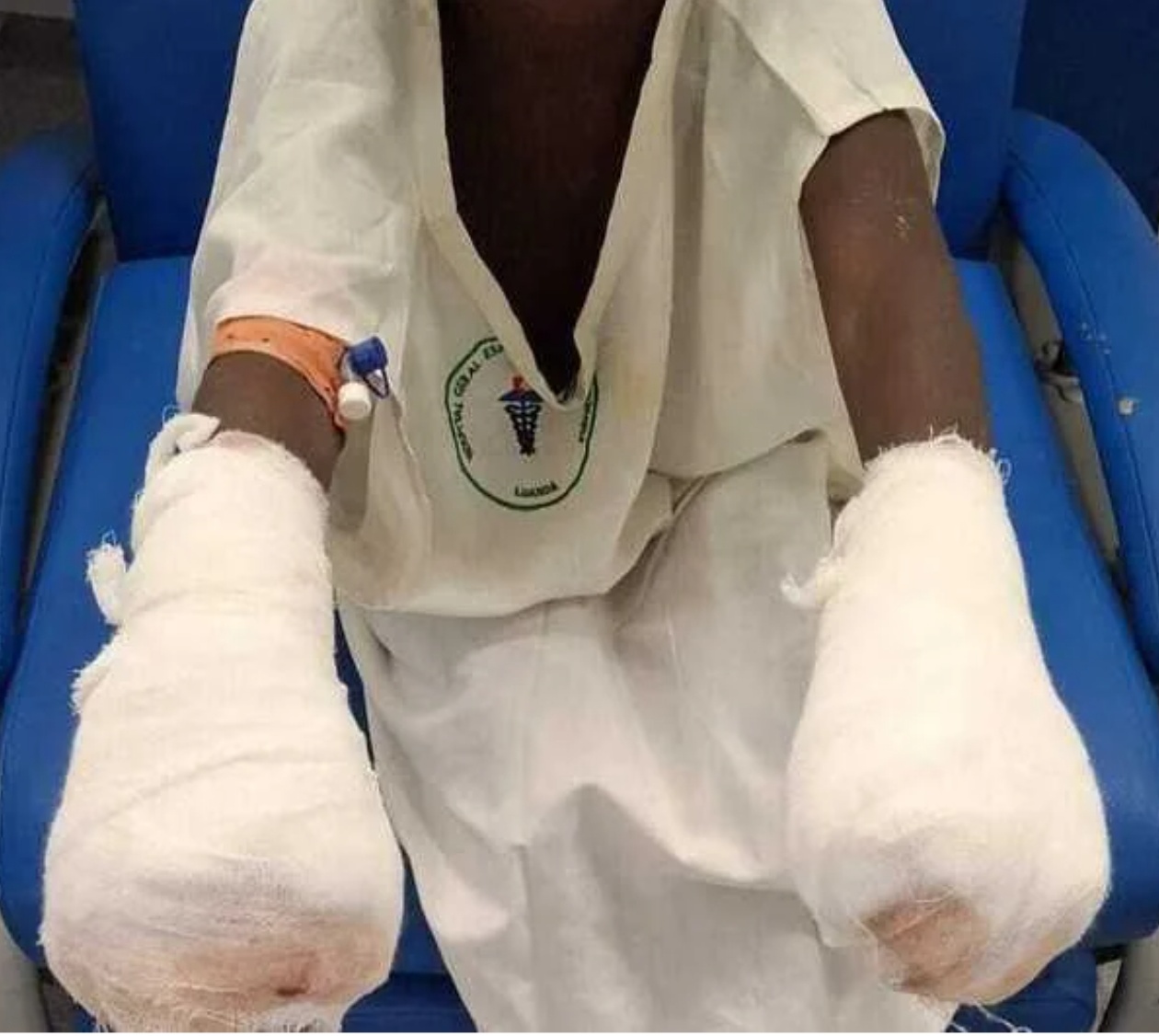 Pai é suspeito de queimar mãos de dois filhos por alegado furto de 100 kwanzas